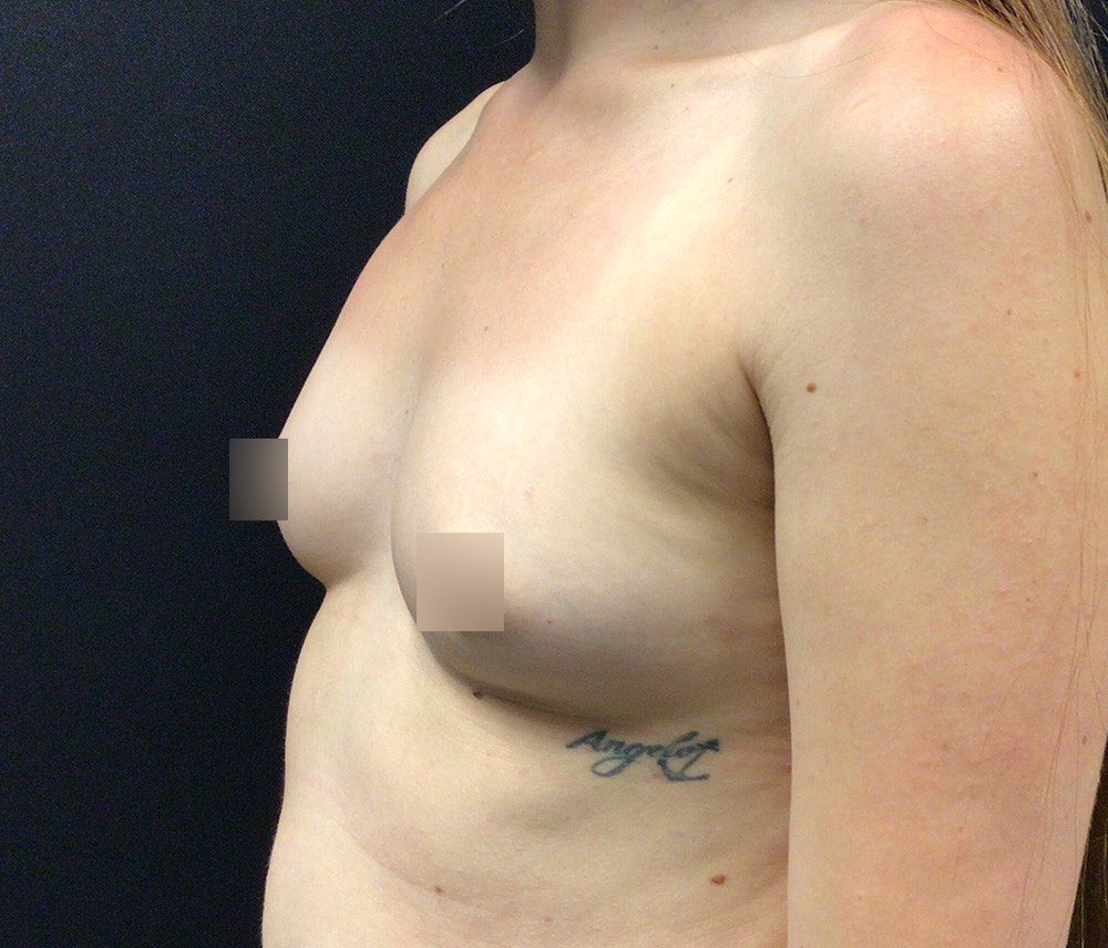 Breast Augmentation Before & After Gallery - Patient 102617290 - Image 5