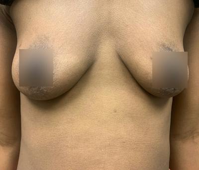 Breast Augmentation Before & After Gallery - Patient 102617289 - Image 1