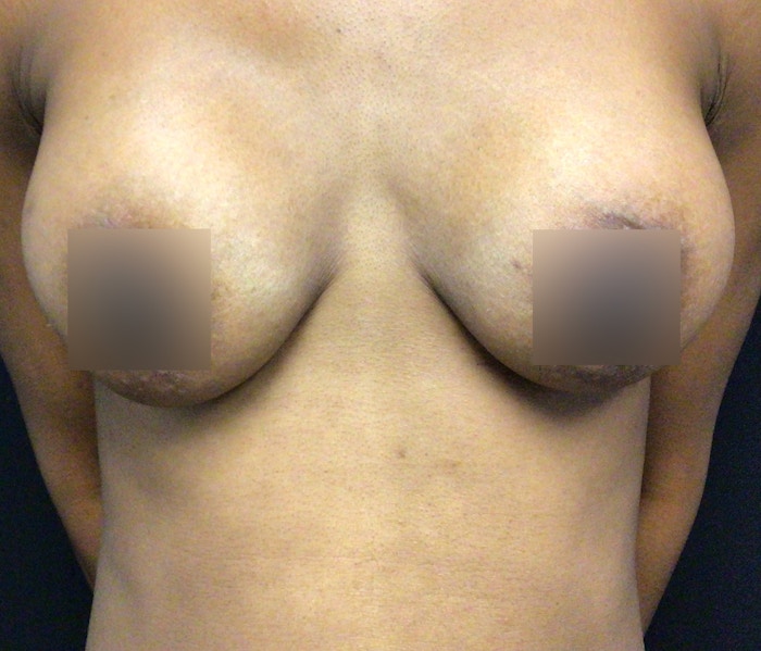 Breast Augmentation Before & After Gallery - Patient 102617289 - Image 2