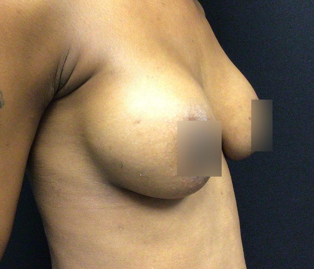 Breast Augmentation Before & After Gallery - Patient 102617289 - Image 4