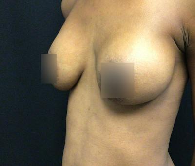 Breast Augmentation Before & After Gallery - Patient 102617289 - Image 6