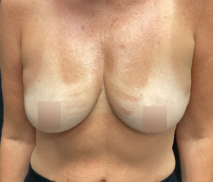 Breast Augmentation Before & After Gallery - Patient 102617288 - Image 1