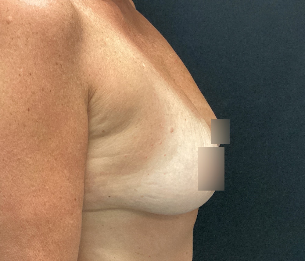 Breast Augmentation Before & After Gallery - Patient 102617288 - Image 3