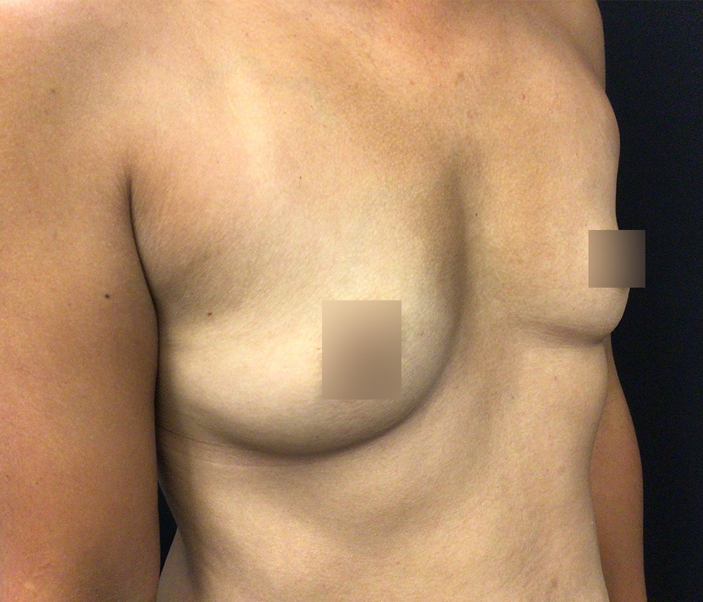 Breast Augmentation Before & After Gallery - Patient 62153385 - Image 5