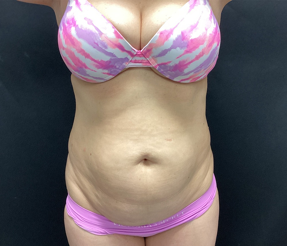 Liposuction Before & After Gallery - Patient 102617587 - Image 1