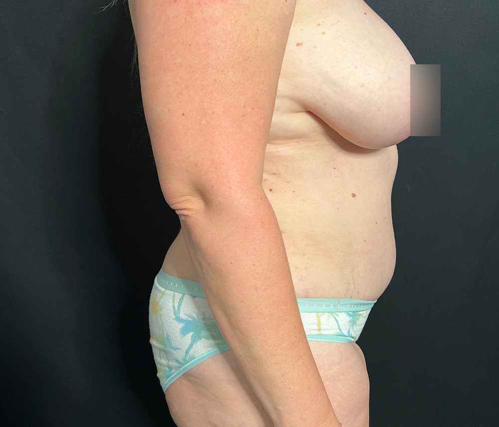 Lipo 360 Before & After Gallery - Patient 102617602 - Image 4