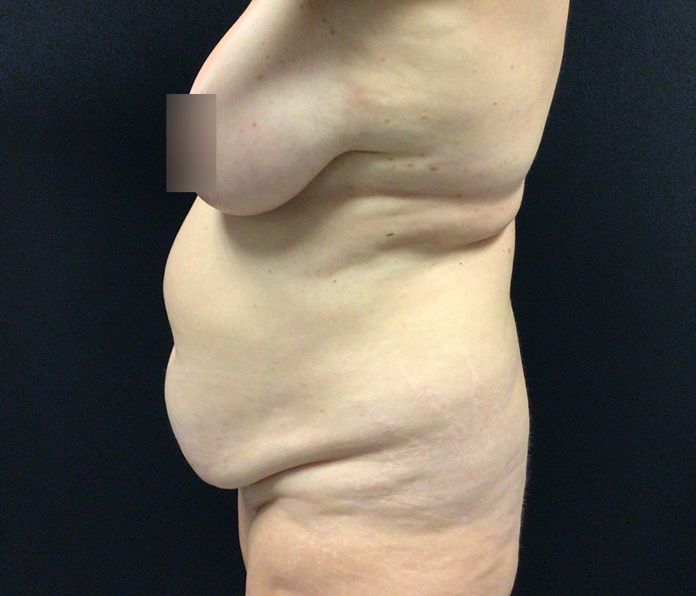 Lipo 360 Before & After Gallery - Patient 102617602 - Image 5