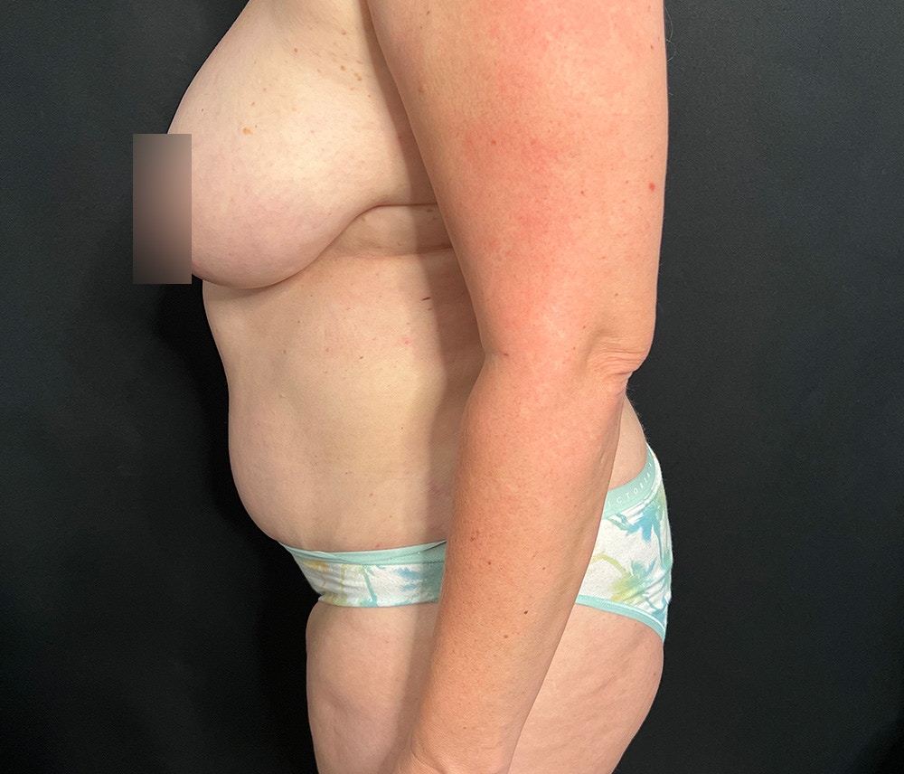 Lipo 360 Before & After Gallery - Patient 102617602 - Image 6