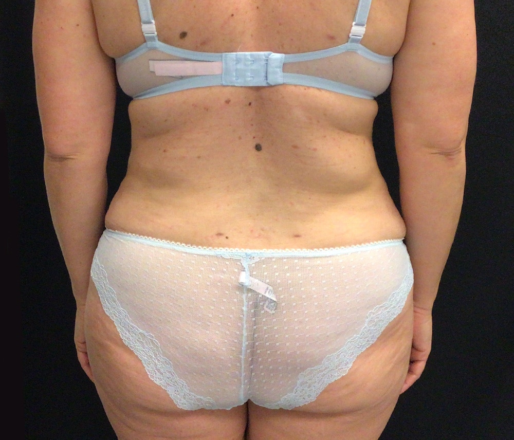 Lipo 360 Before & After Gallery - Patient 102617602 - Image 8
