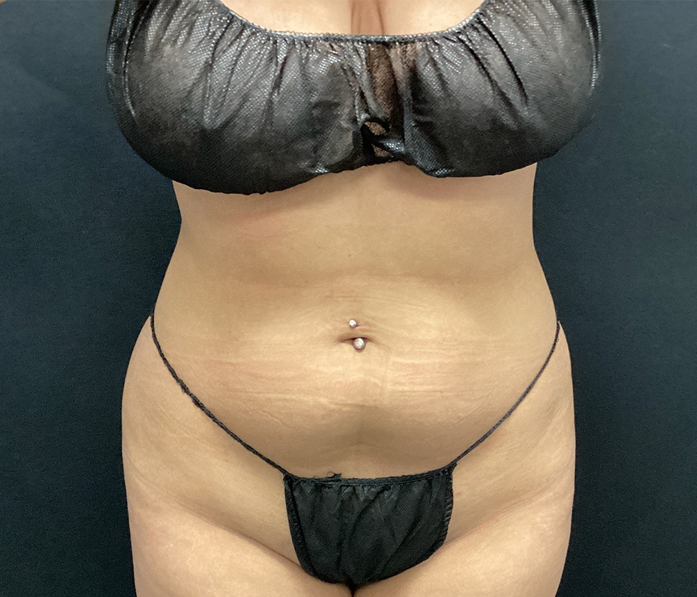 Liposuction Before & After Gallery - Patient 102617617 - Image 1