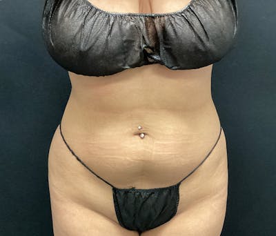 Liposuction Before & After Gallery - Patient 102617617 - Image 1