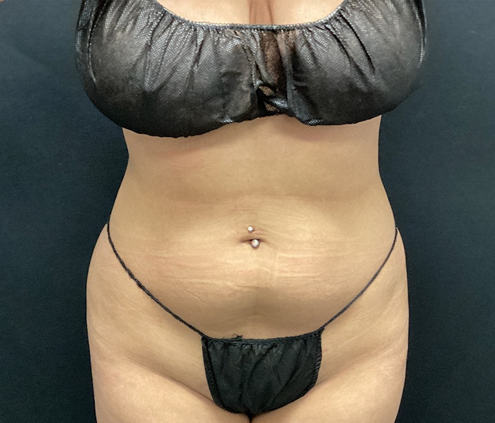 Lipo 360 Before & After Gallery - Patient 102617617 - Image 1