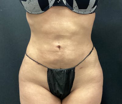 Liposuction Before & After Gallery - Patient 102617617 - Image 2