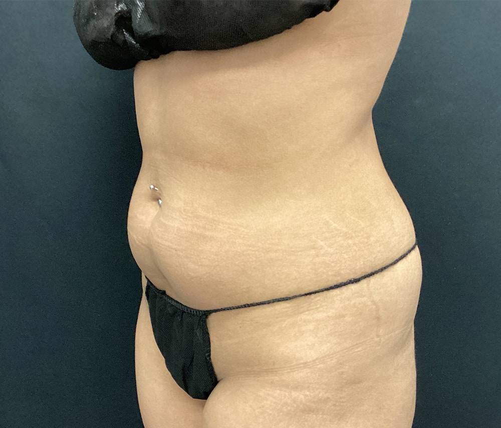 Lipo 360 Before & After Gallery - Patient 102617617 - Image 3