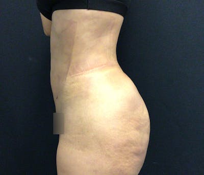Liposuction Before & After Gallery - Patient 102617617 - Image 6