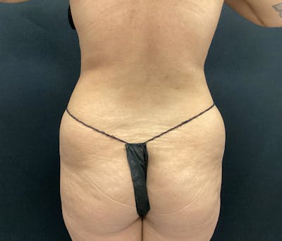 Liposuction Before & After Gallery - Patient 102617617 - Image 7