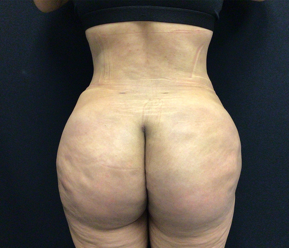Liposuction Before & After Gallery - Patient 102617617 - Image 8