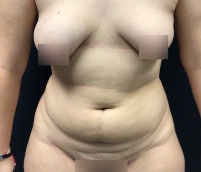 Liposuction Before & After Gallery - Patient 102617648 - Image 1