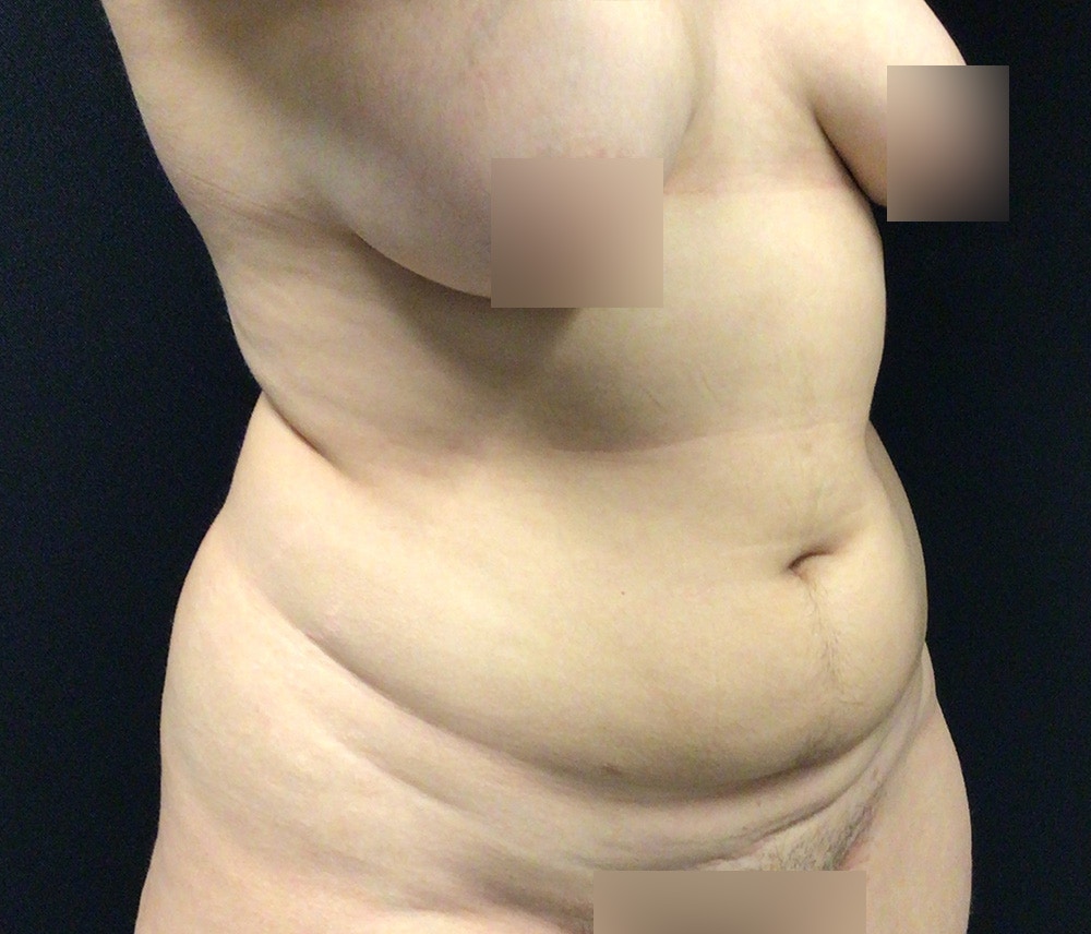 Lipo 360 Before & After Gallery - Patient 102617648 - Image 3