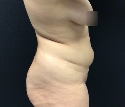 Liposuction Before & After Gallery - Patient 102617648 - Image 5