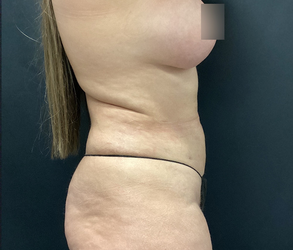 Lipo 360 Before & After Gallery - Patient 102617648 - Image 6