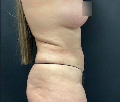 Liposuction Before & After Gallery - Patient 102617648 - Image 6