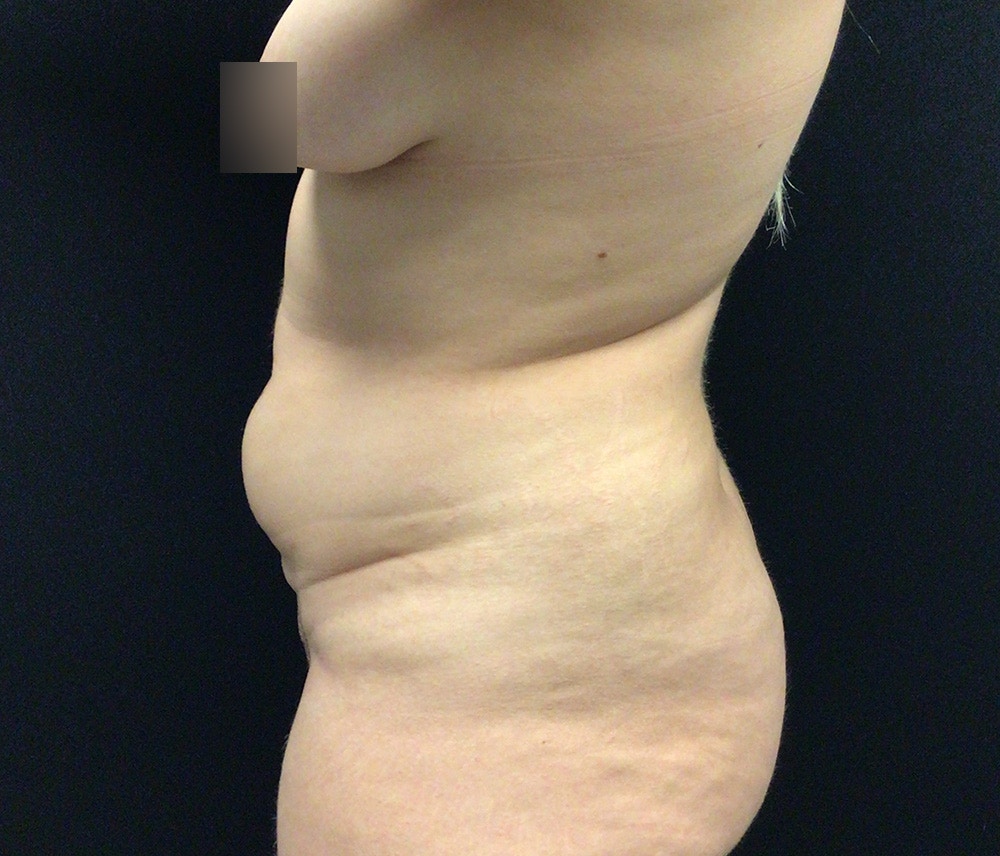 Lipo 360 Before & After Gallery - Patient 102617648 - Image 7
