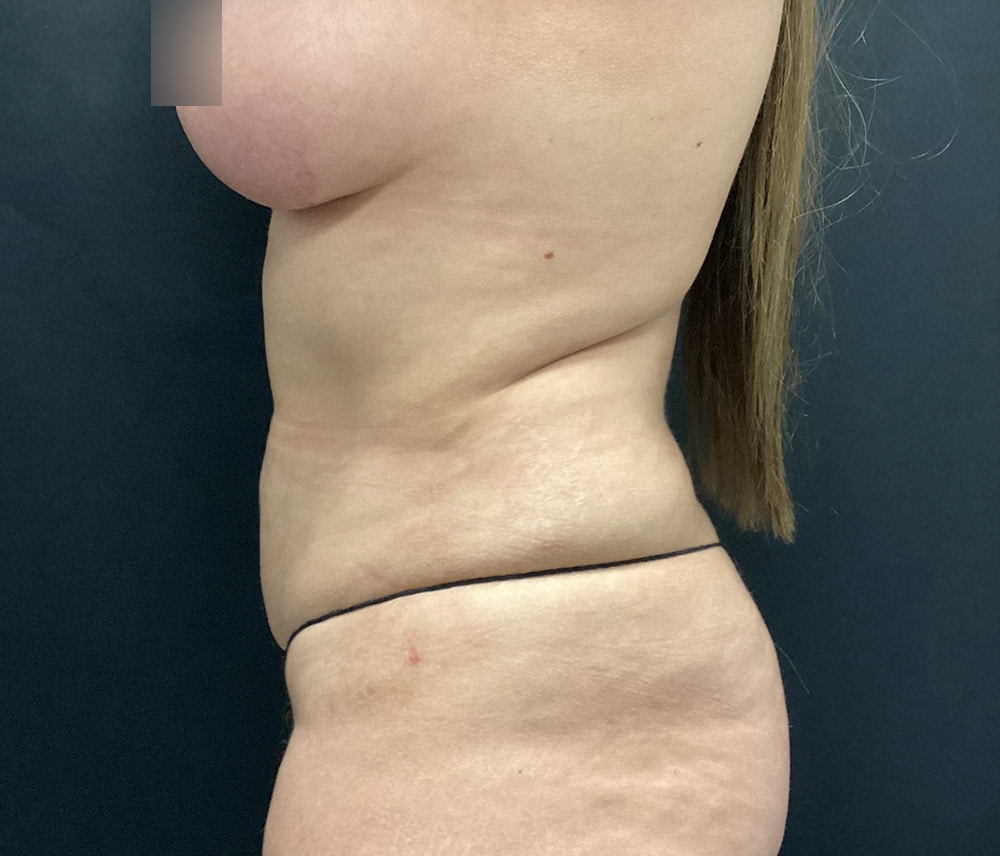Liposuction Before & After Gallery - Patient 102617648 - Image 8