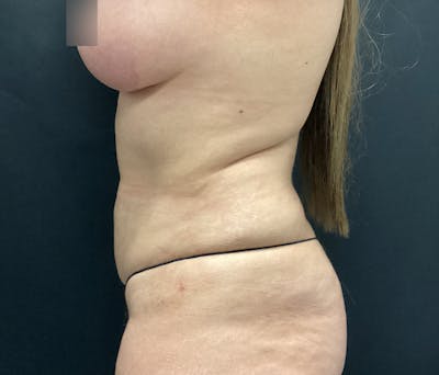 Liposuction Before & After Gallery - Patient 102617648 - Image 8