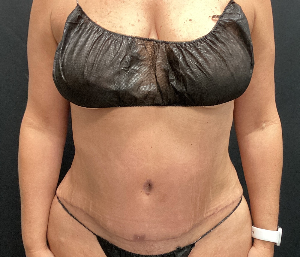 Liposuction Before & After Gallery - Patient 102617647 - Image 2