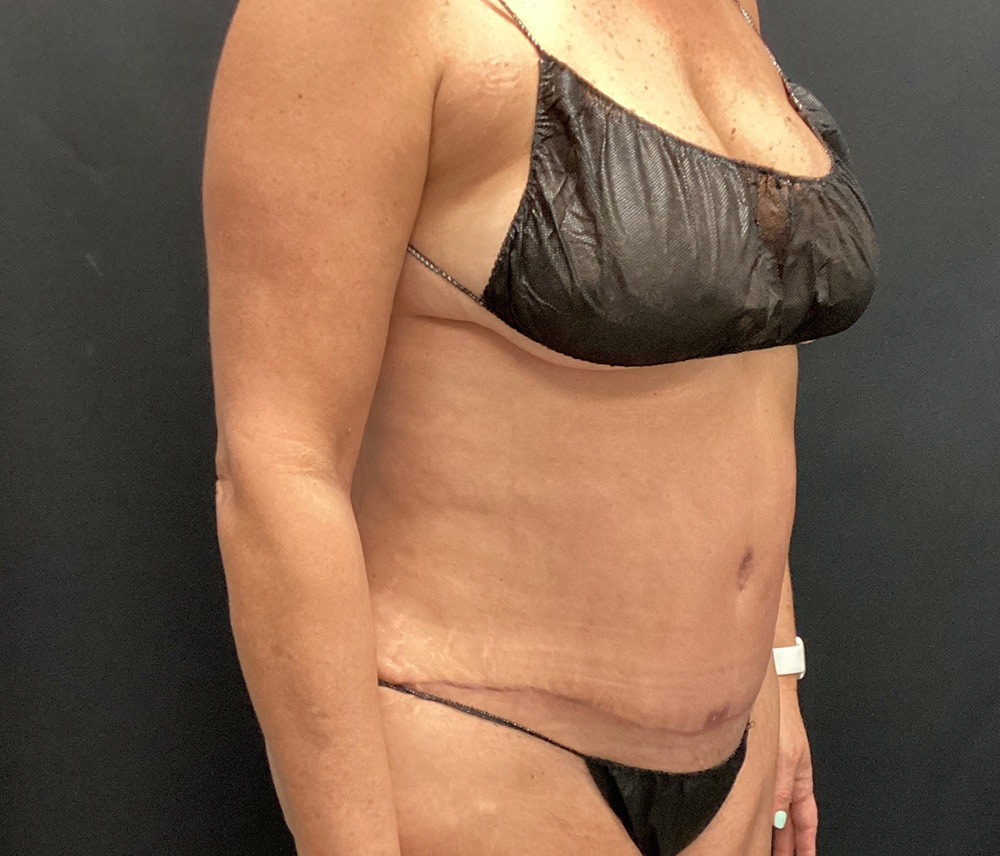 Liposuction Before & After Gallery - Patient 102617647 - Image 6