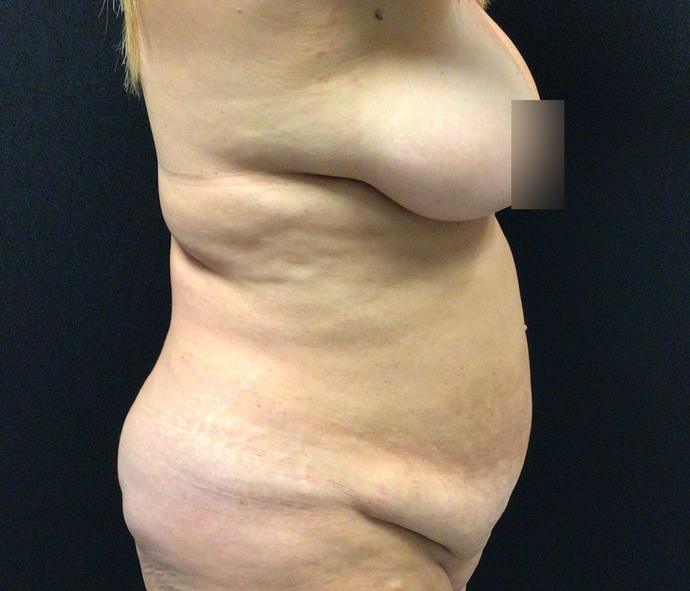 Liposuction Before & After Gallery - Patient 102617647 - Image 7