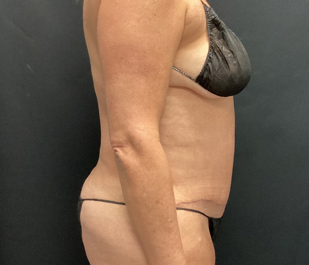 Liposuction Before & After Gallery - Patient 102617647 - Image 8