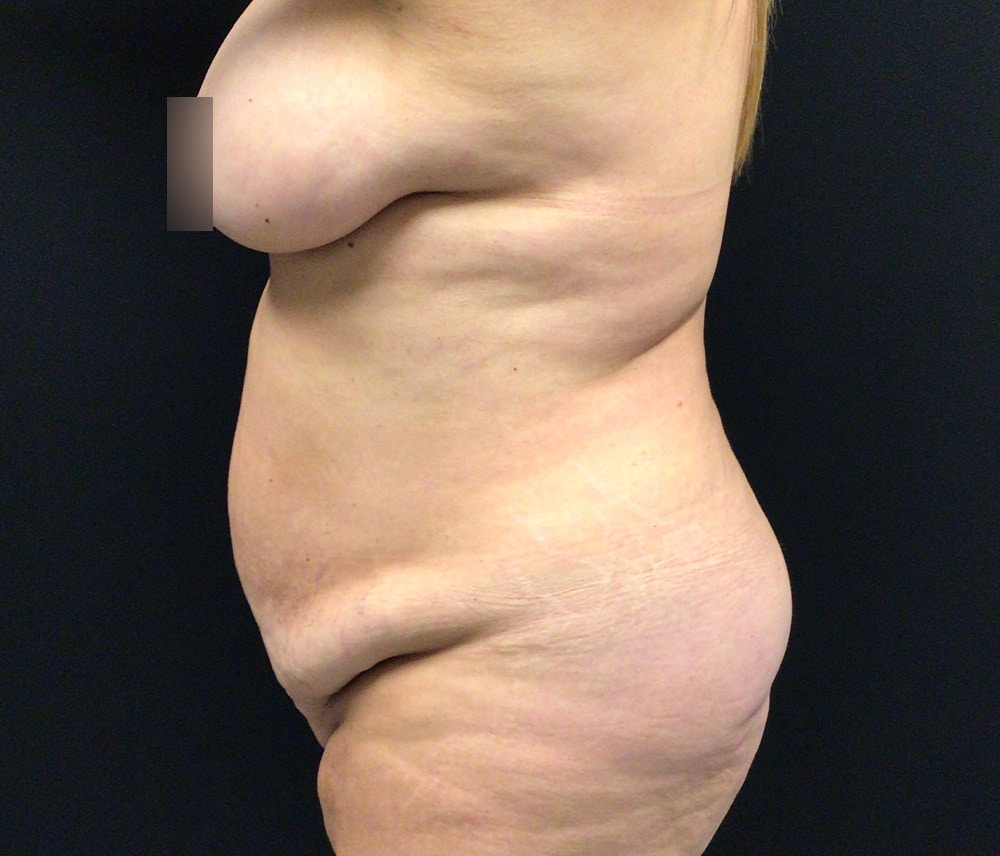 Liposuction Before & After Gallery - Patient 102617647 - Image 9