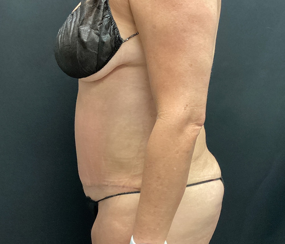 Liposuction Before & After Gallery - Patient 102617647 - Image 10