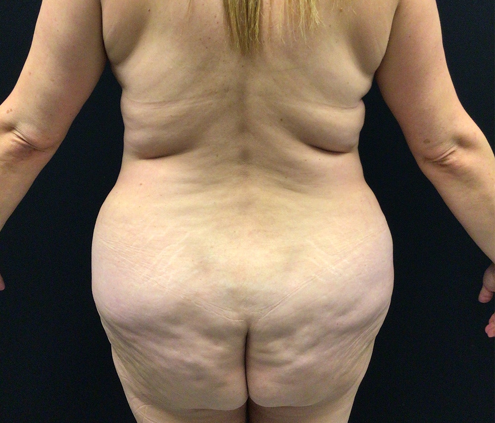 Liposuction Before & After Gallery - Patient 102617647 - Image 11