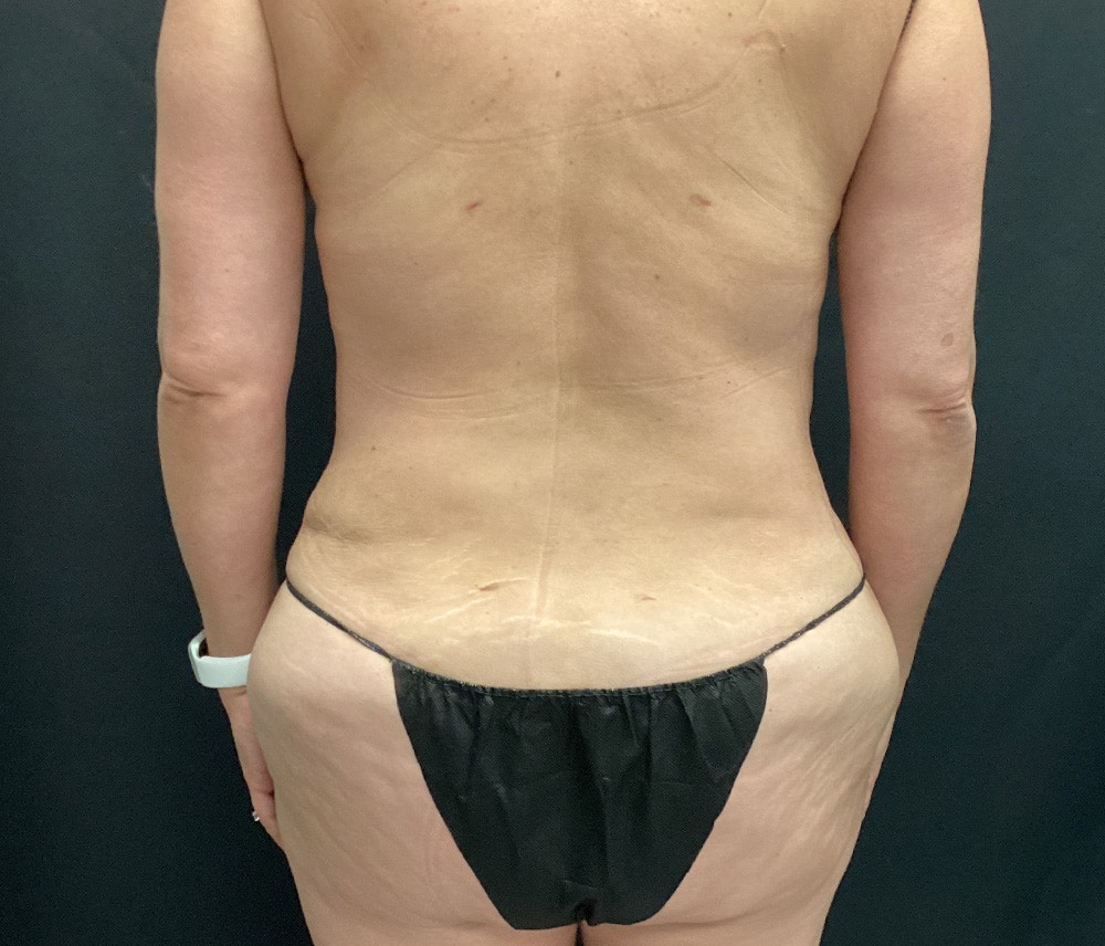 Lipo 360 Before & After Gallery - Patient 102617647 - Image 12