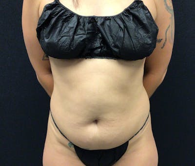 Liposuction Before & After Gallery - Patient 102619905 - Image 1