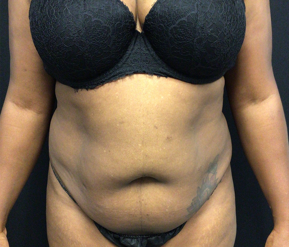 Lipo 360 Before & After Gallery - Patient 102619904 - Image 1