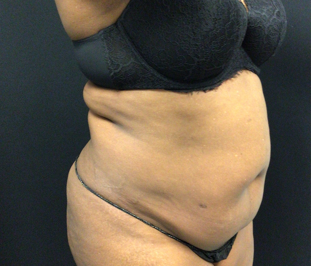 Lipo 360 Before & After Gallery - Patient 102619904 - Image 3