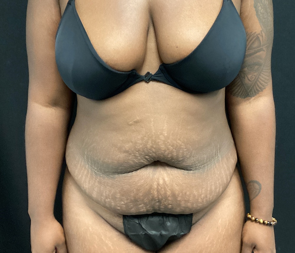 Liposuction Before & After Gallery - Patient 102619920 - Image 1
