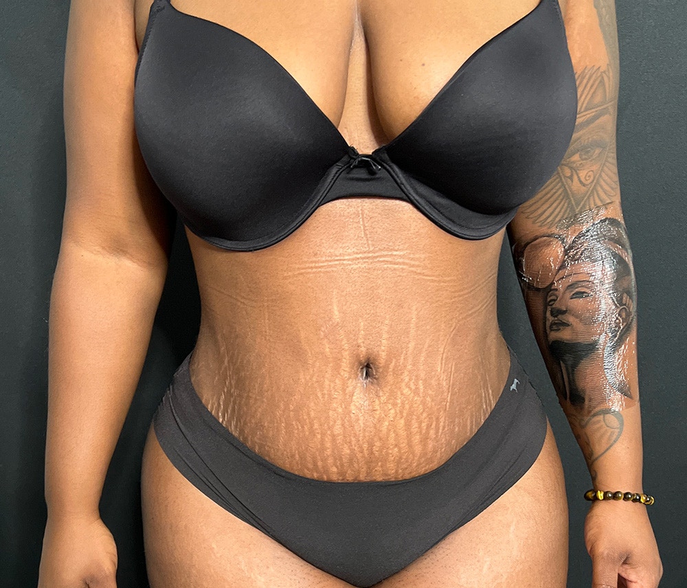 Liposuction Before & After Gallery - Patient 102619920 - Image 2