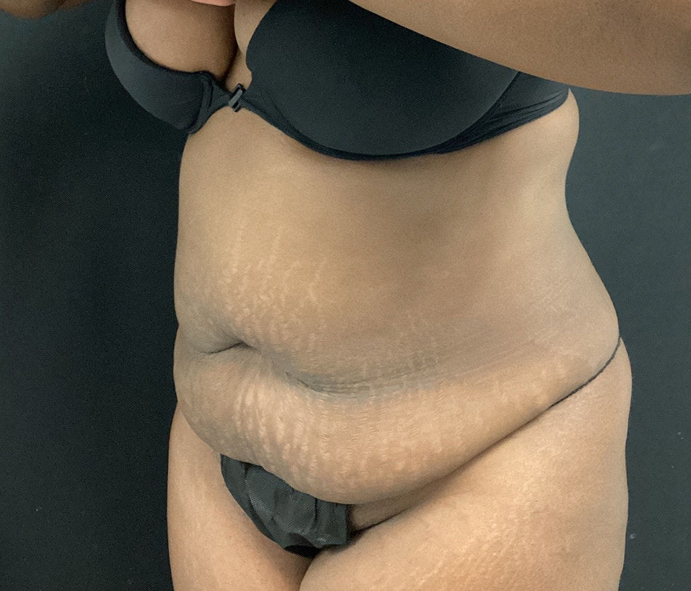 Liposuction Before & After Gallery - Patient 102619920 - Image 3