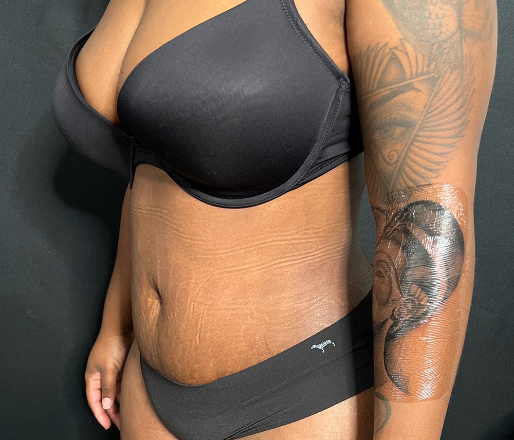 Lipo 360 Before & After Gallery - Patient 102619920 - Image 4