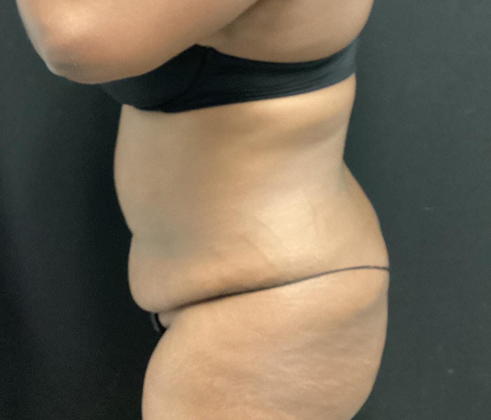 Liposuction Before & After Gallery - Patient 102619920 - Image 5