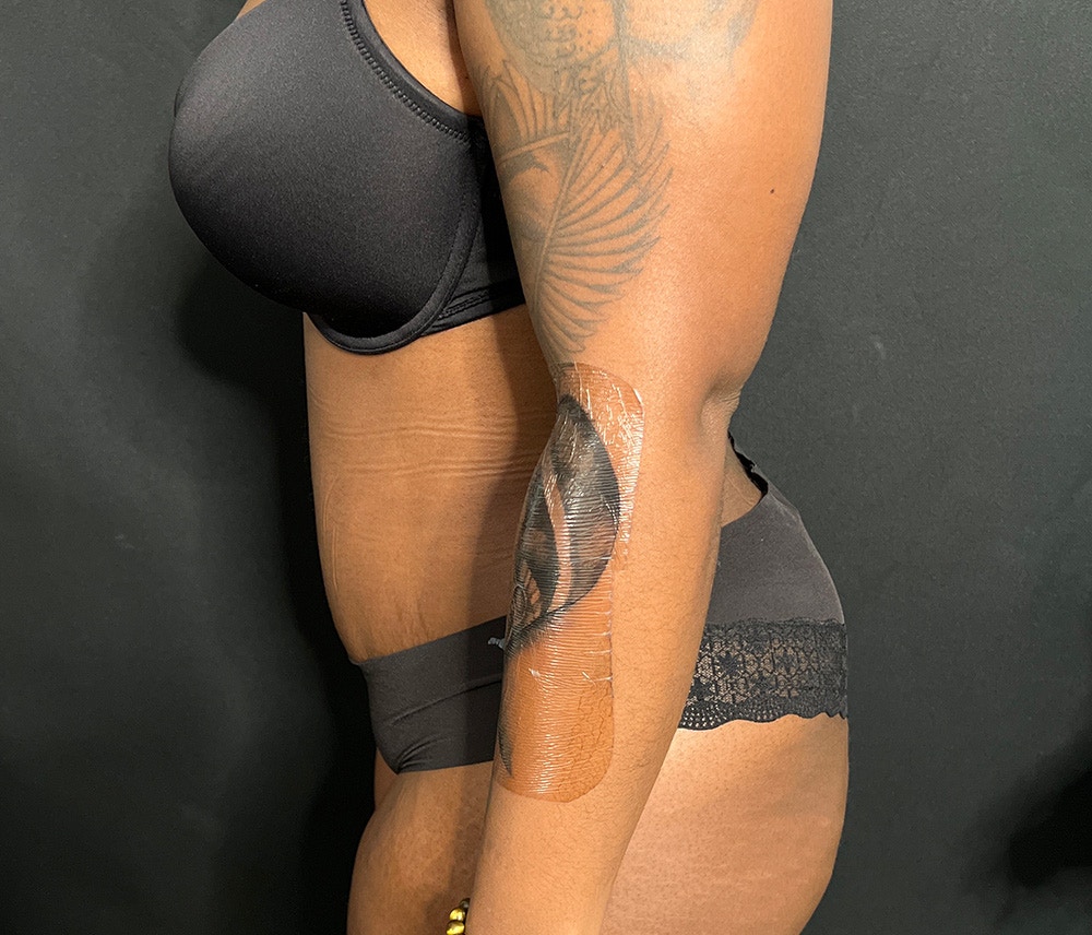 Liposuction Before & After Gallery - Patient 102619920 - Image 6