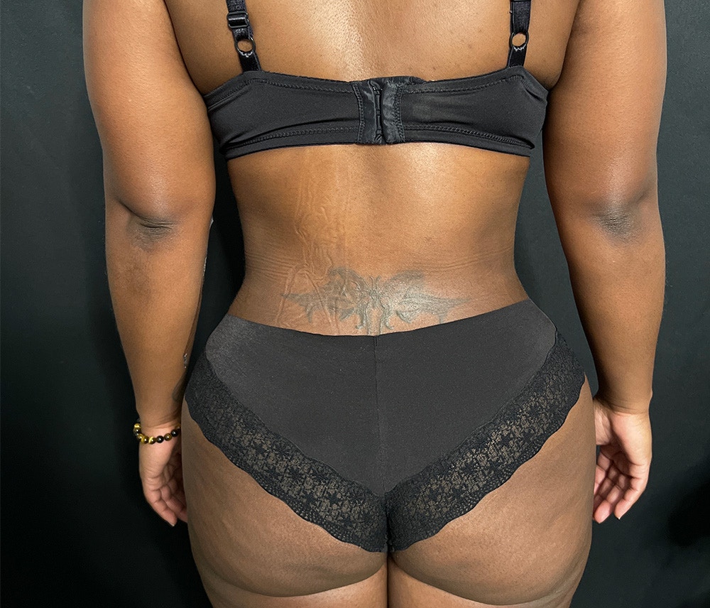 Liposuction Before & After Gallery - Patient 102619920 - Image 8