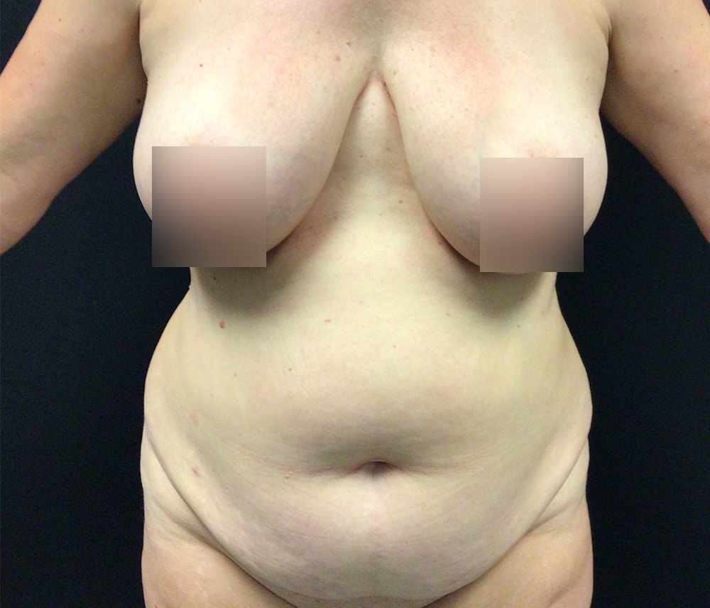 Liposuction Before & After Gallery - Patient 102619935 - Image 1
