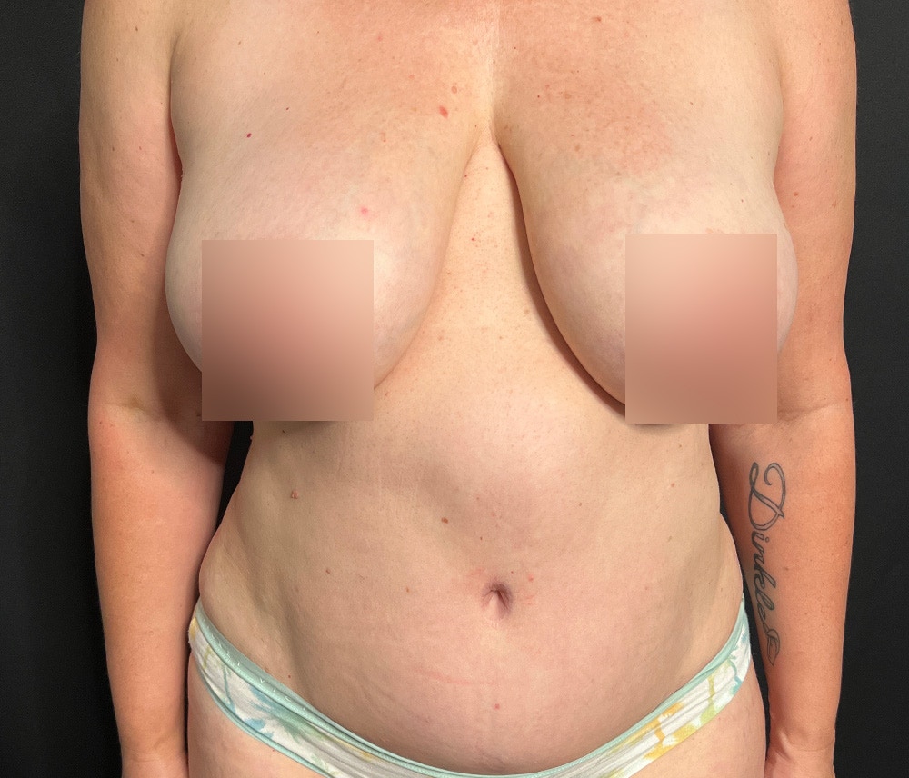 Liposuction Before & After Gallery - Patient 102619935 - Image 2