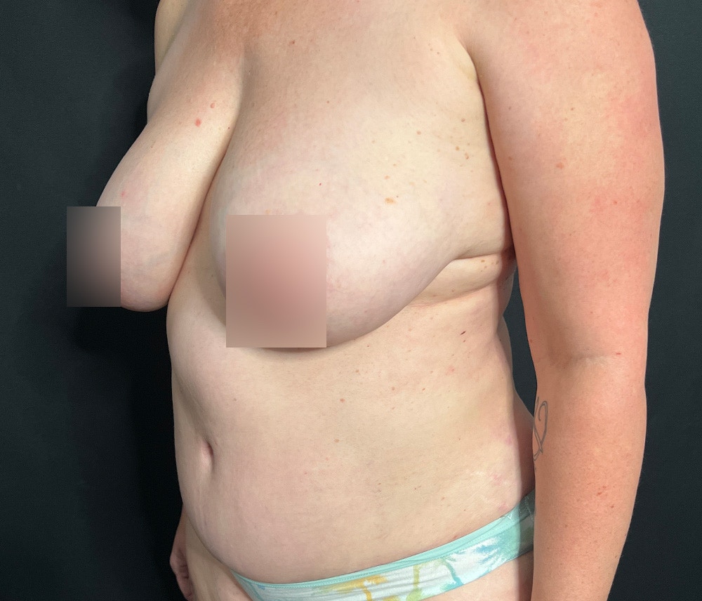 Liposuction Before & After Gallery - Patient 102619935 - Image 6